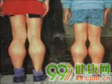 偶有重症可有后遗症手足口病是什么