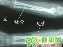 运动迟缓