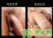 大多数患者预后良好早泄(PE)