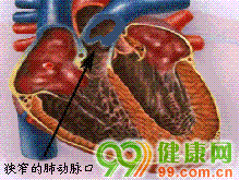 肺动脉口狭窄指右心室漏斗部