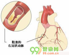 风湿性二尖瓣关闭不全是风湿热侵犯二尖