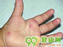 继续了解又称儿童急性短暂肌炎
